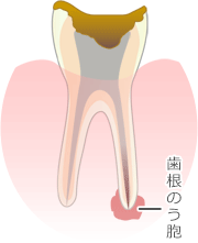 歯根のう胞摘出術