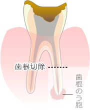 歯根端切除術