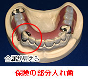 保険の部分入れ歯