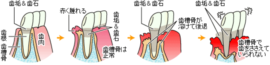 歯周病の進行