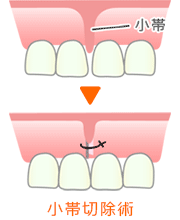 歯科用半導体ダイオードレーザー治療器