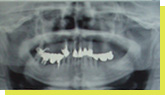 歯列全体のパノラマレントゲン写真