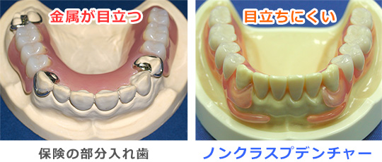 ノンクラスプデンチャーと保険の入れ歯の比較