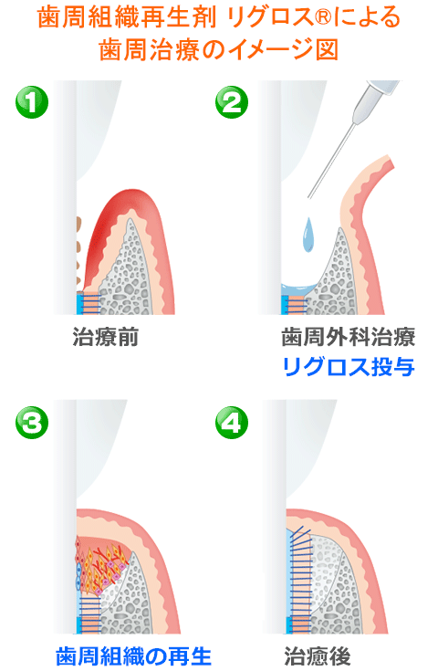 歯周組織再生剤 リグロス®による歯周治療のイメージ図