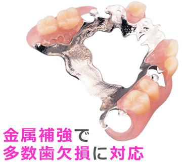 金属補強で多数歯欠損に対応したエステショット（部分入れ歯）