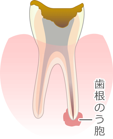 歯根のう胞摘出術