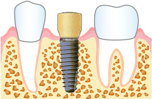 ＳＴＥＰ２ インプラント埋入手術：歯肉の成形・縫合
