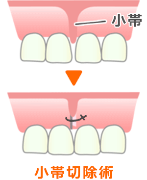 歯科用半導体ダイオードレーザー治療器
