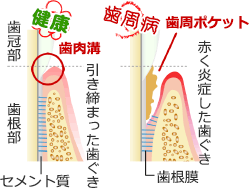 健康な歯ぐきと歯周病の歯ぐき