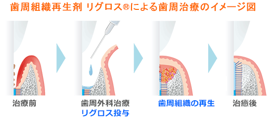 歯周組織再生剤 リグロス®による歯周治療のイメージ図