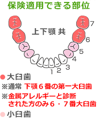 ハイブリッドCAD/CAM冠を保険適用できる部位