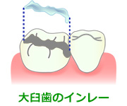 大臼歯のインレー