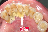歯と歯ぐきの境に溜まった歯石