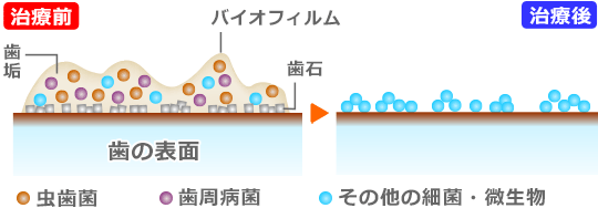 虫歯や歯周病の原因菌を直接退治！ ３ＤＳ除菌治療